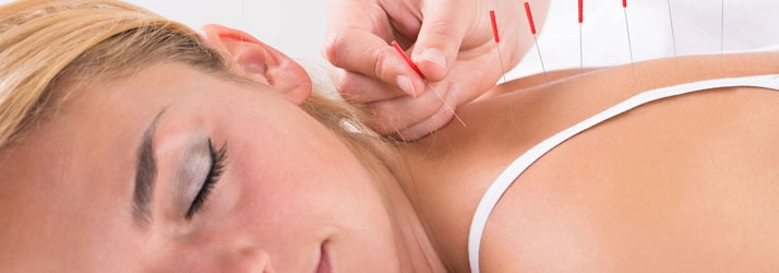 Chiropractic Wellington FL Dry Needling